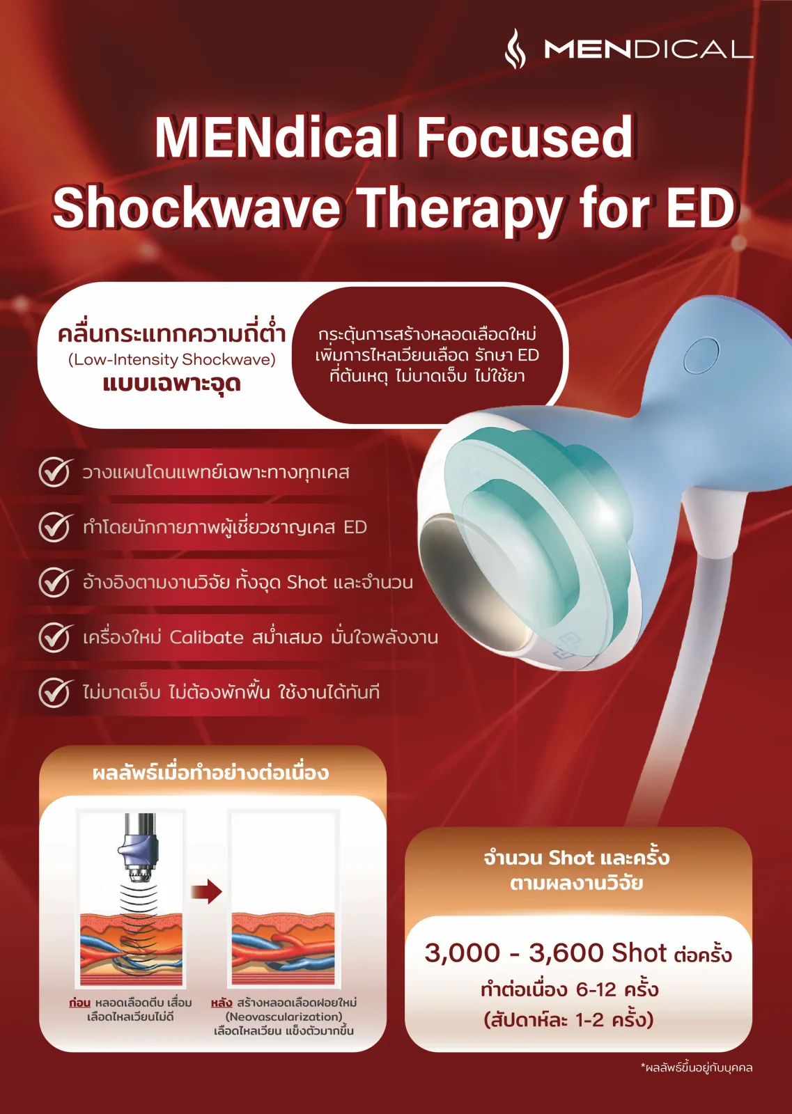 Focused Shockwave Therapy (Li-ESWT) สำหรับ ED — MENdical Clinic