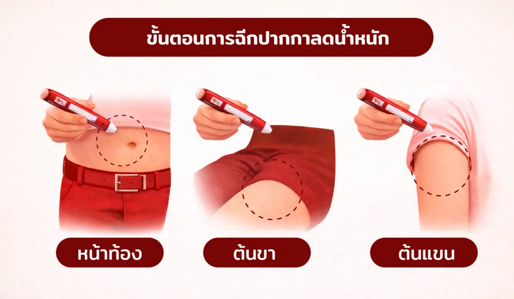 วิธีการฉีดปากกาลดน้ำหนัก บริเวณหน้าท้อง ต้นขา และต้นแขน
